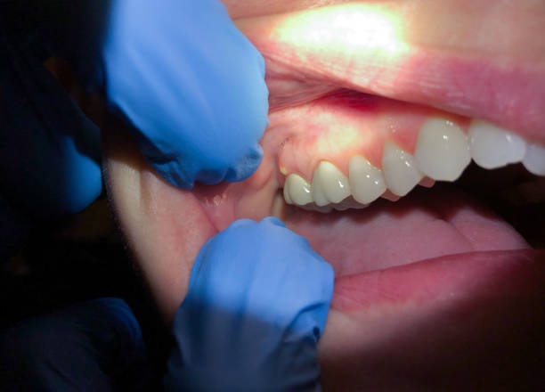 Best Broken or Cracked Tooth Emergency Dentist in Bethany, WV